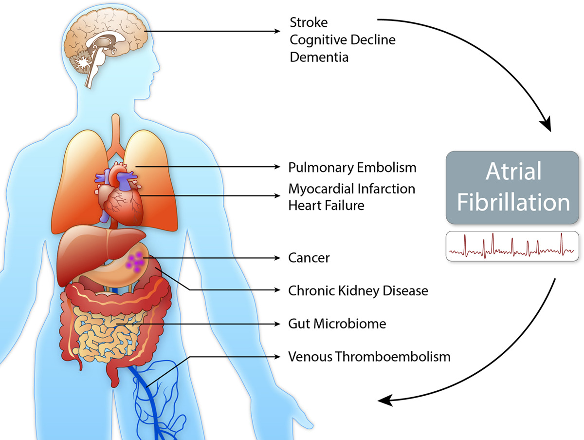 Illustration showing atrial fibrillation and associated health risks across organ systems
