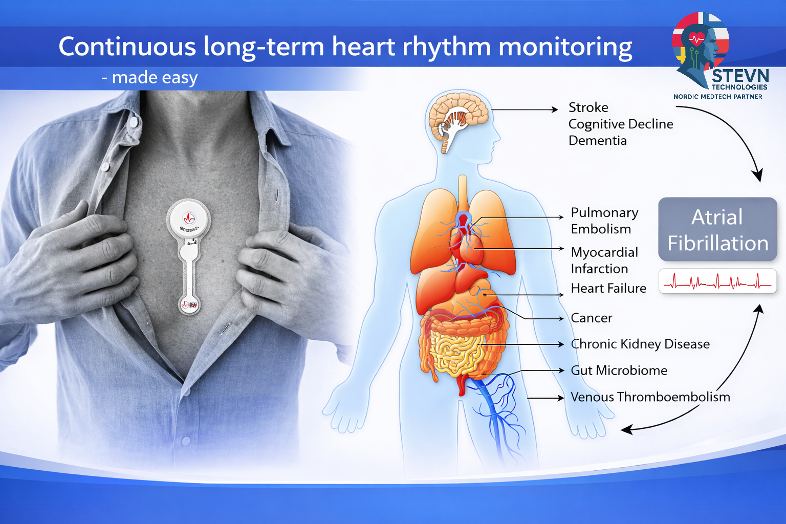 ECG247 Smart Heart Sensor ja havainnollistus eteisvärinän ja vakavien komplikaatioiden yhteydestä